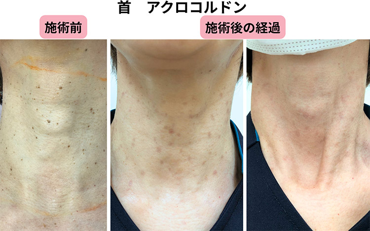 アクロコルドンの症例