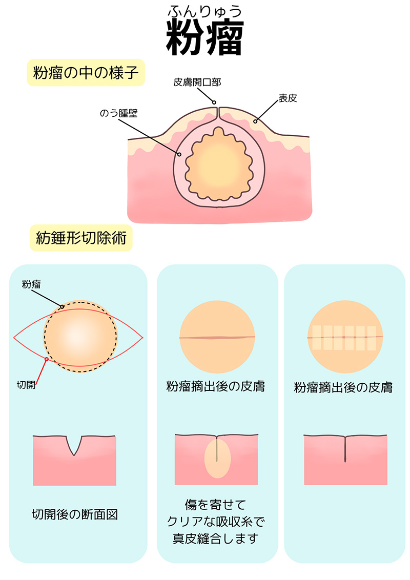 粉瘤の手術のイメージ画像